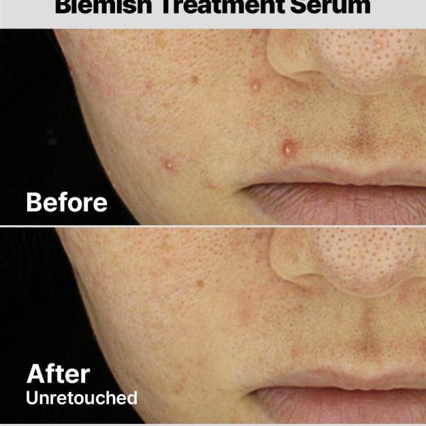The AHA 2 BHA 2 Blemish Treatment Serum