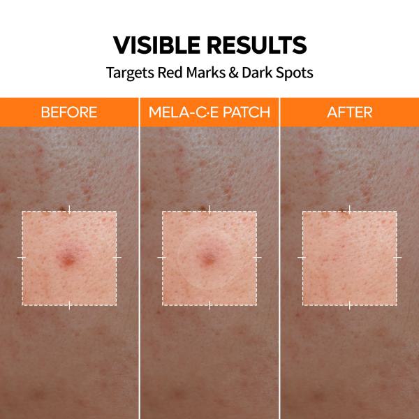 Zero Fit Blemish &amp; Dark Spot Patch Duo